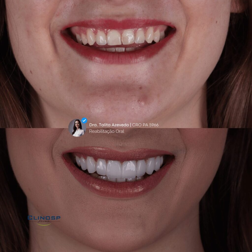 PAISAGEM-ANTES-E-DEPOIS-FACETAS-1-1-1024x1024